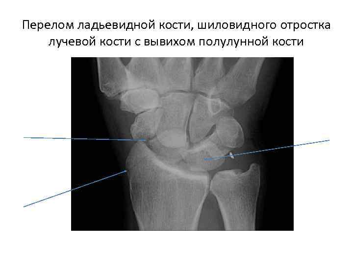 Перелом ладьевидной кости, шиловидного отростка лучевой кости с вывихом полулунной кости 