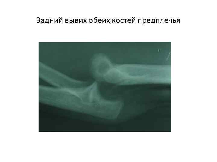 Задний вывих обеих костей предплечья 