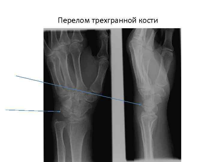 Перелом трехгранной кости 