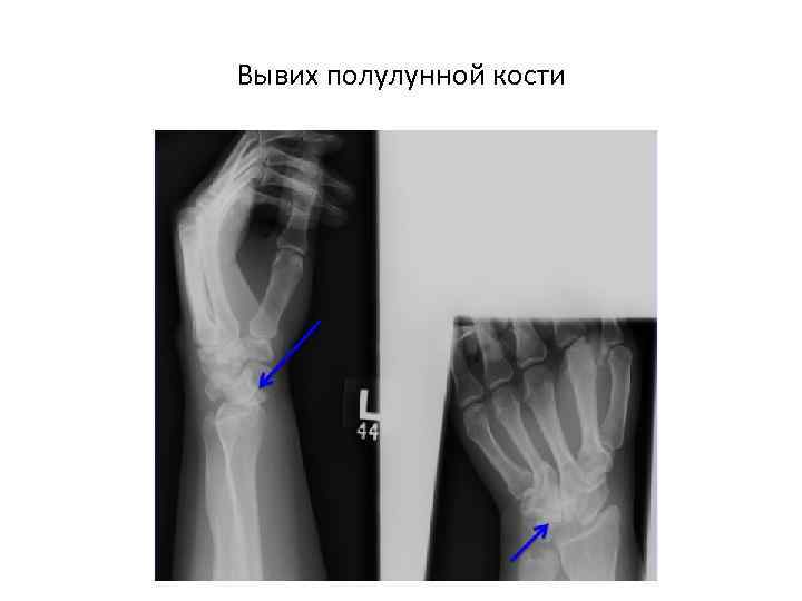 Вывих полулунной кости 