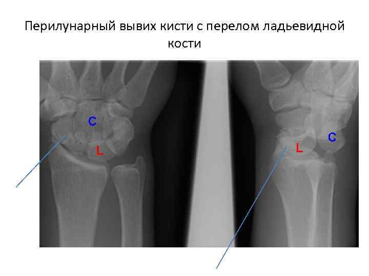 Перилунарный вывих кисти с перелом ладьевидной     кости 