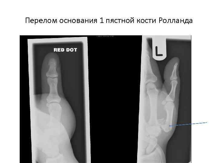 Перелом основания 1 пястной кости Ролланда 