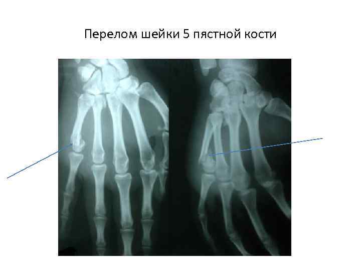 Перелом шейки 5 пястной кости 