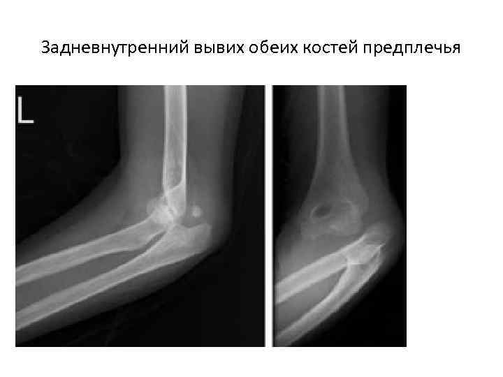 Задневнутренний вывих обеих костей предплечья 