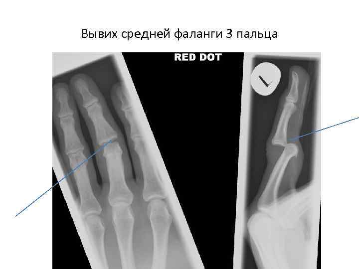 Вывих средней фаланги 3 пальца 