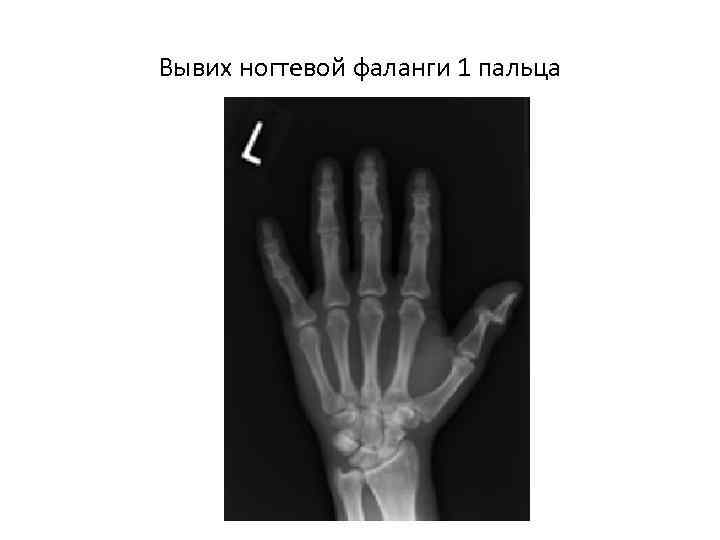 Вывих ногтевой фаланги 1 пальца 