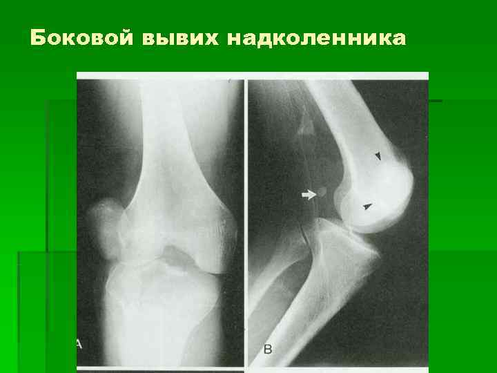 Боковой вывих надколенника 