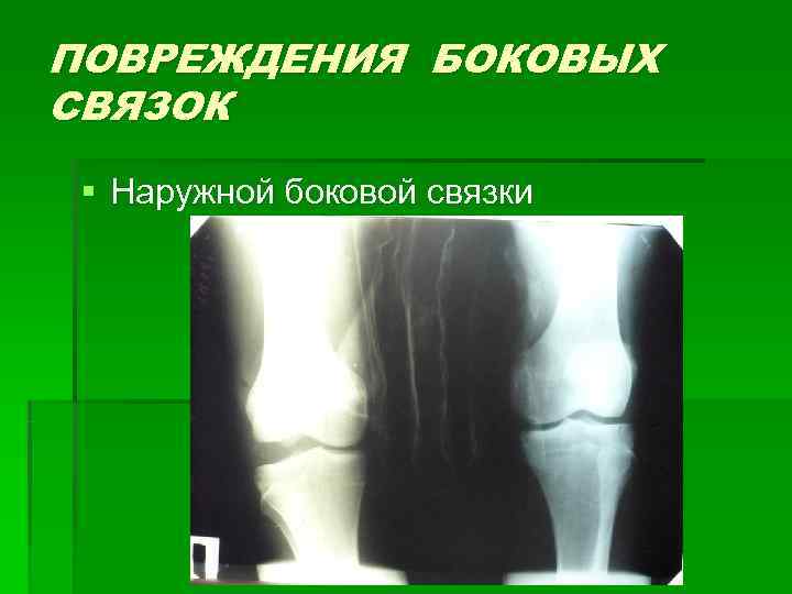 ПОВРЕЖДЕНИЯ БОКОВЫХ СВЯЗОК § Наружной боковой связки 