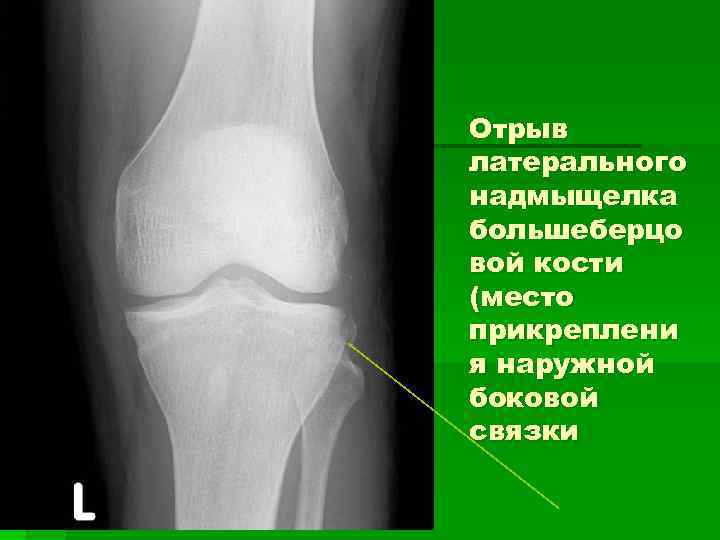 Отрыв латерального надмыщелка большеберцо вой кости (место прикреплени я наружной боковой связки 