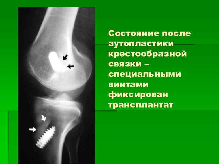 Состояние после аутопластики крестообразной связки – специальными винтами фиксирован трансплантат 