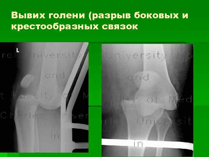 Вывих голени (разрыв боковых и крестообразных связок 