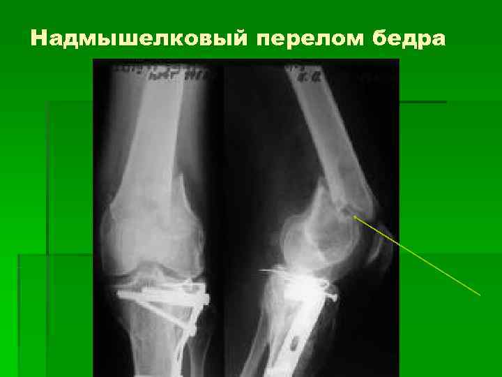 Надмышелковый перелом бедра 