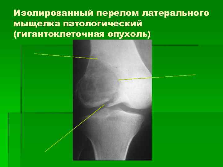 Изолированный перелом латерального мыщелка патологический (гигантоклеточная опухоль) 