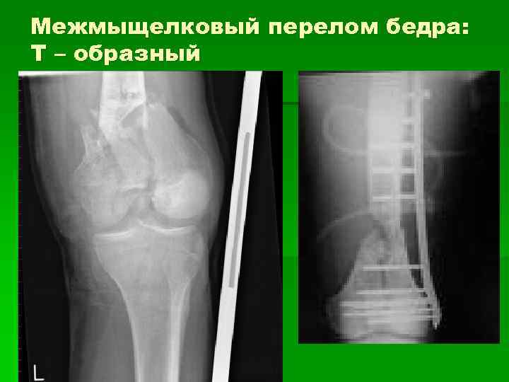 Межмыщелковый перелом бедра: Т – образный 