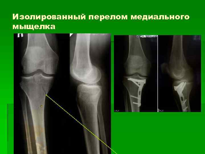 Изолированный перелом медиального мыщелка 