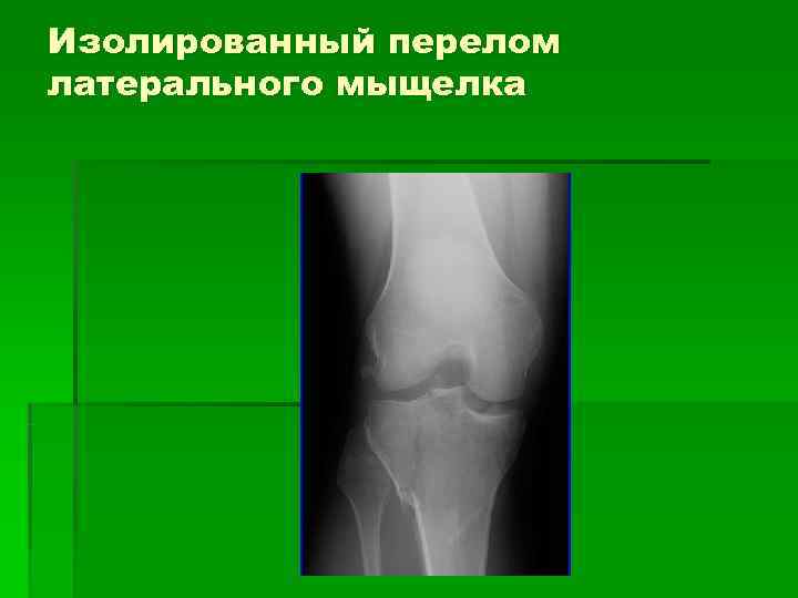 Изолированный перелом латерального мыщелка 