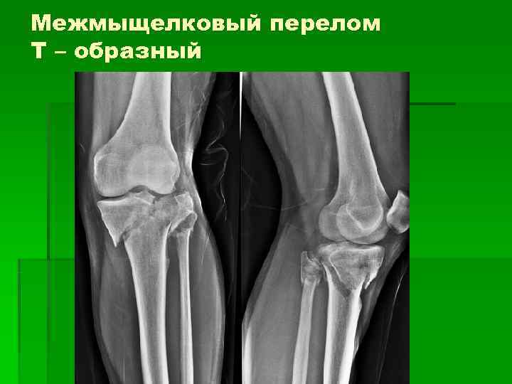 Межмыщелковый перелом Т – образный 