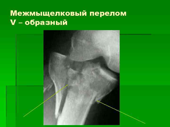 Межмыщелковый перелом V – образный 