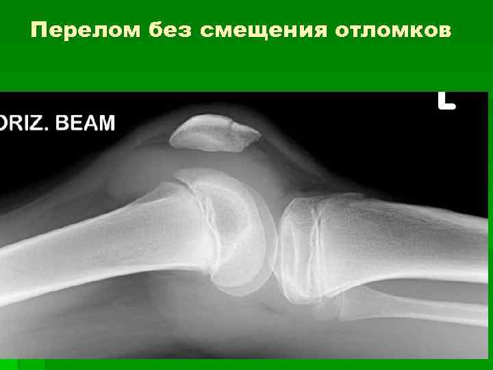 Перелом без смещения отломков 