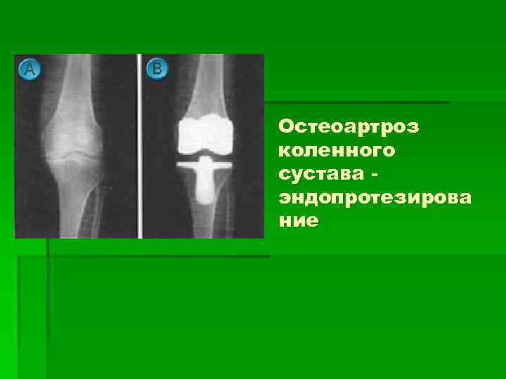 Остеоартроз коленного сустава - эндопротезирова ние 