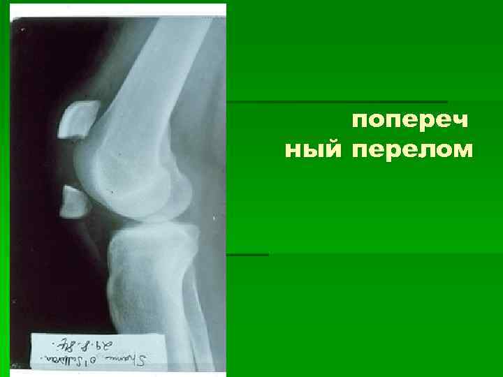   попереч ный перелом 