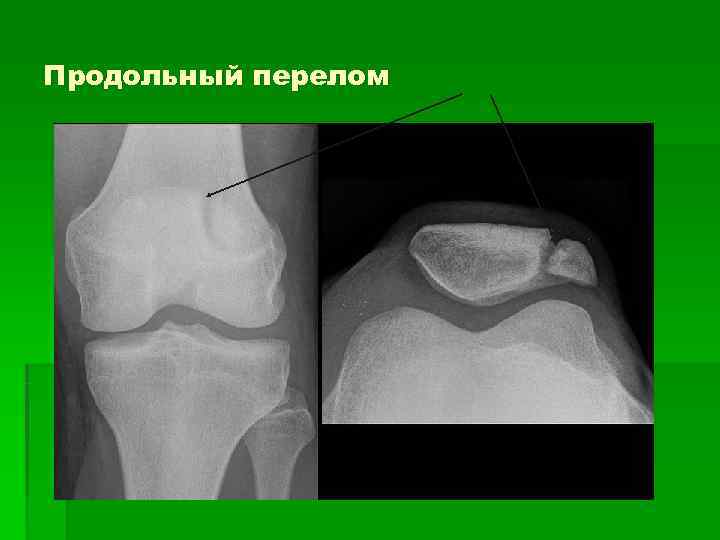 Продольный перелом 