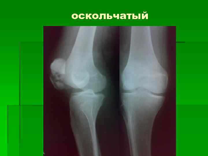 оскольчатый 