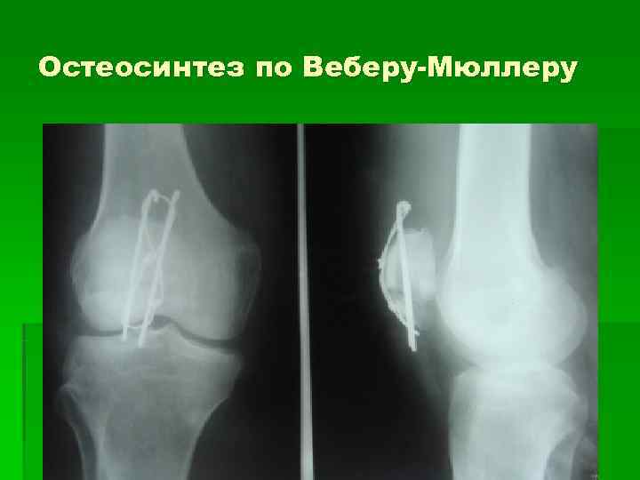 Остеосинтез по Веберу-Мюллеру 