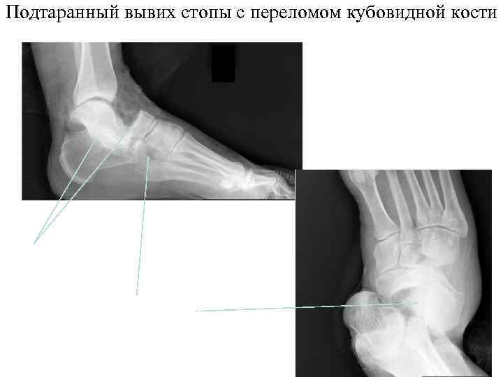 >Подтаранный вывих стопы с переломом кубовидной кости 