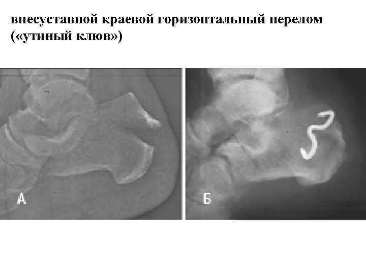 >внесуставной краевой горизонтальный перелом ( «утиный клюв» ) 