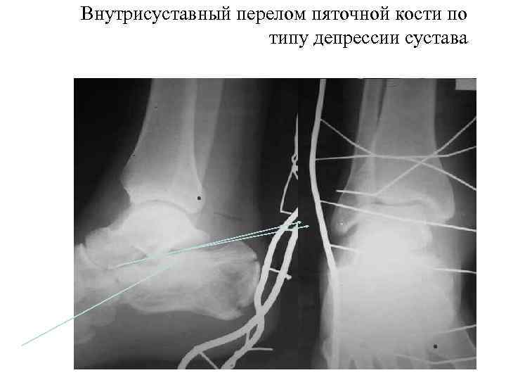 >Внутрисуставный перелом пяточной кости по    типу депрессии сустава 