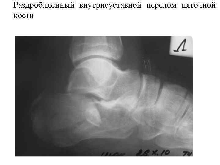 >Раздроблленный внутрисуставной перелом пяточной кости 