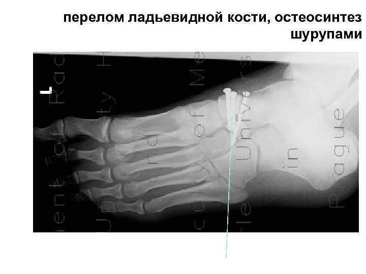 >перелом ладьевидной кости, остеосинтез     шурупами 