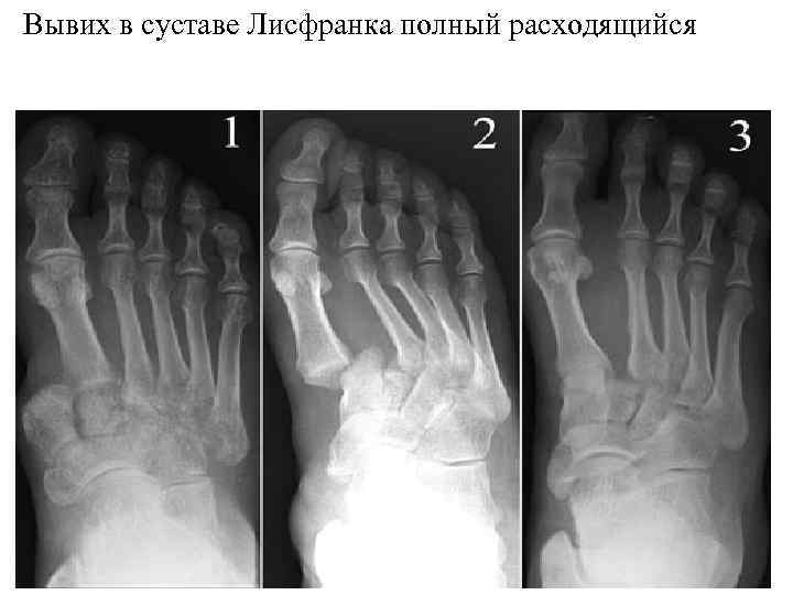 >Вывих в суставе Лисфранка полный расходящийся 