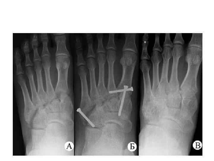 >латеральный вывих I-V плюсневых костей левой стопы в суставе Лисфранка, закрытый перелом ладьевидной кости,