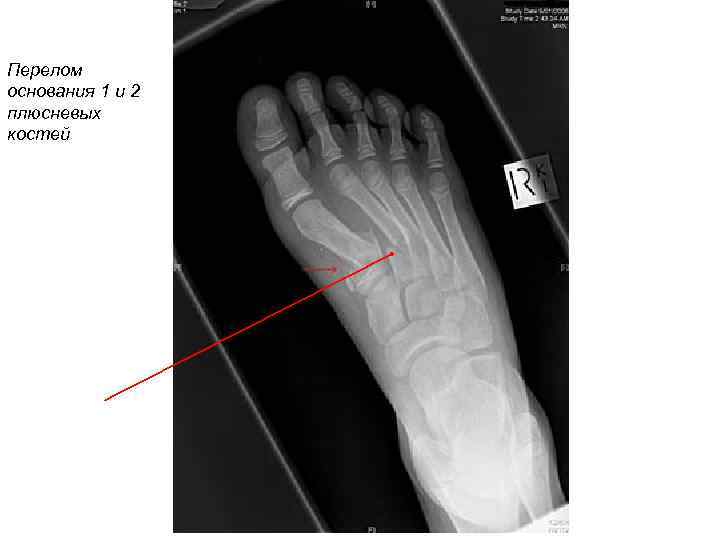 >Перелом основания 1 и 2 плюсневых костей 