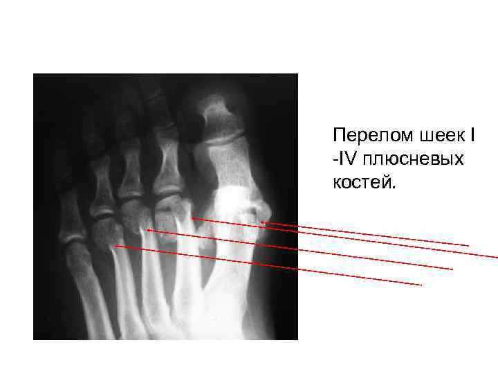 >Перелом шеек I -IV плюсневых костей. 