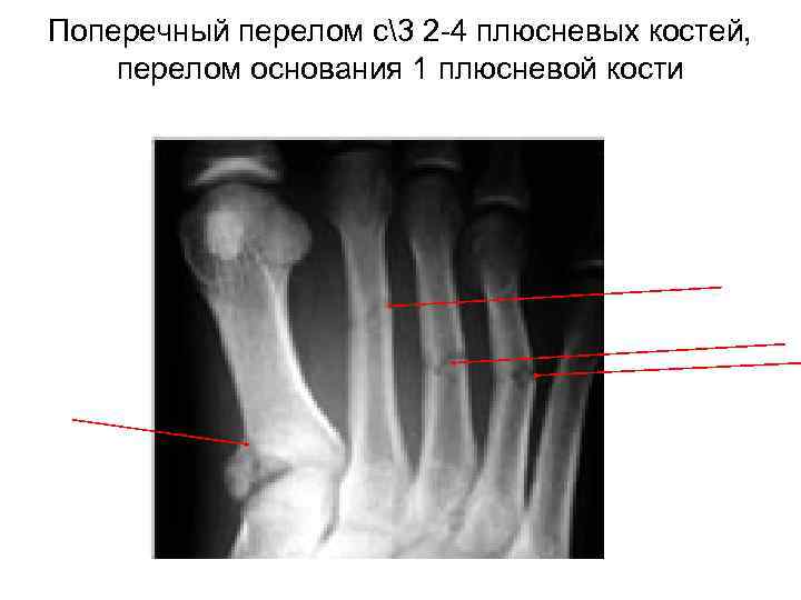 Перелом основания плюсневой кости стопы