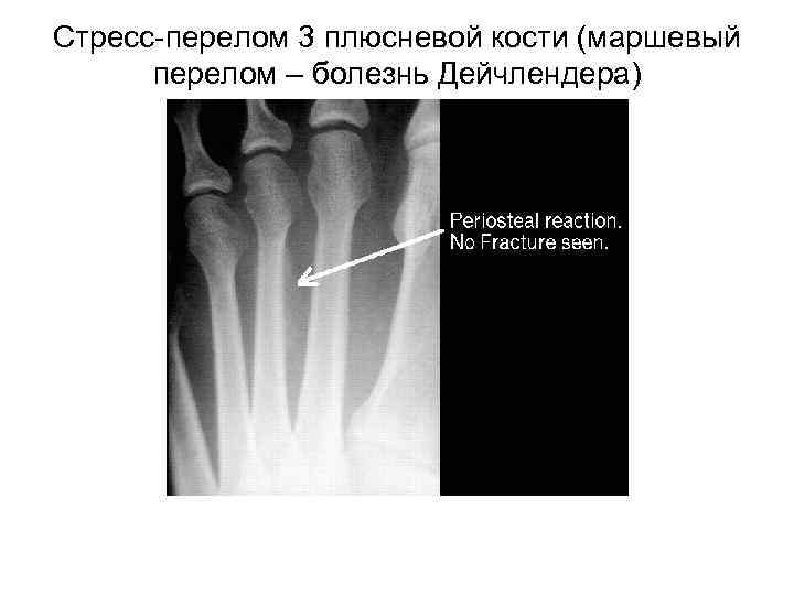 >Стресс-перелом 3 плюсневой кости (маршевый  перелом – болезнь Дейчлендера) 