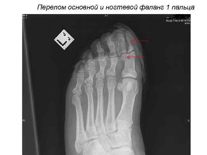 >Перелом основной и ногтевой фаланг 1 пальца 
