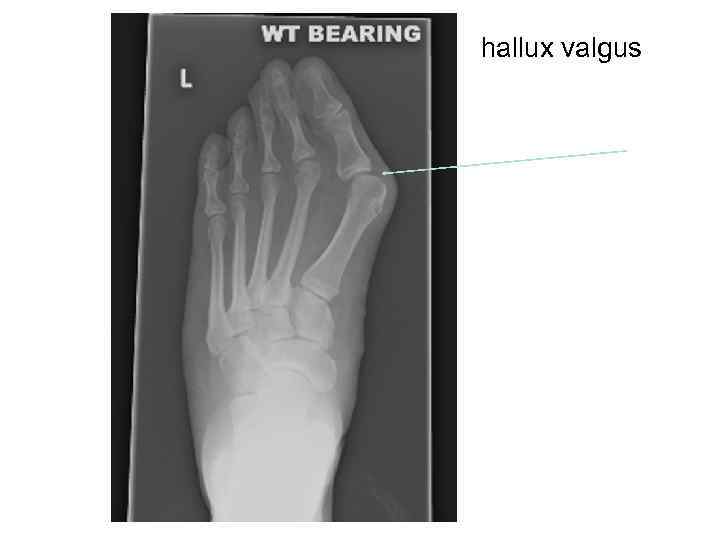 >hallux valgus 