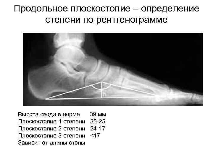 >Продольное плоскостопие – определение  степени по рентгенограмме Высота свода в норме 39 мм