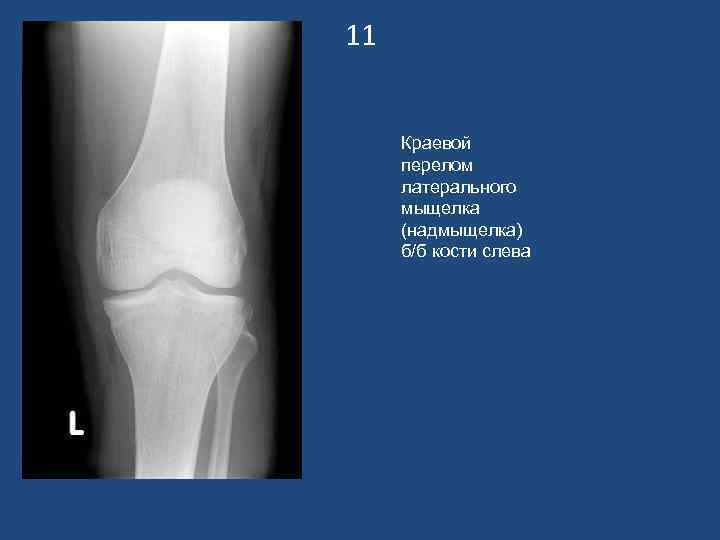 11  Краевой перелом латерального мыщелка (надмыщелка) б/б кости слева 
