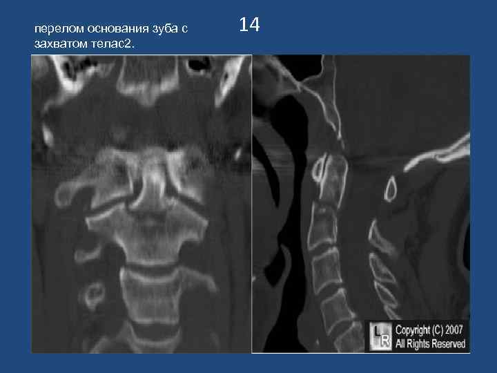 перелом основания зуба с  14 захватом телас2. 