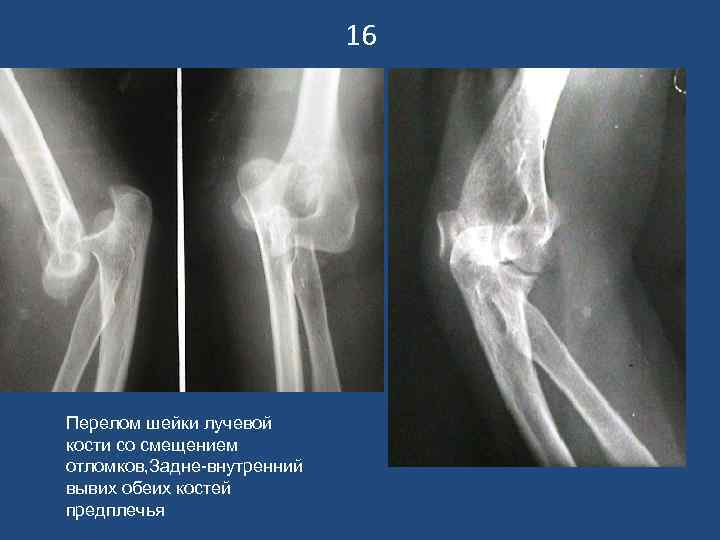       16 Перелом шейки лучевой кости со смещением отломков,