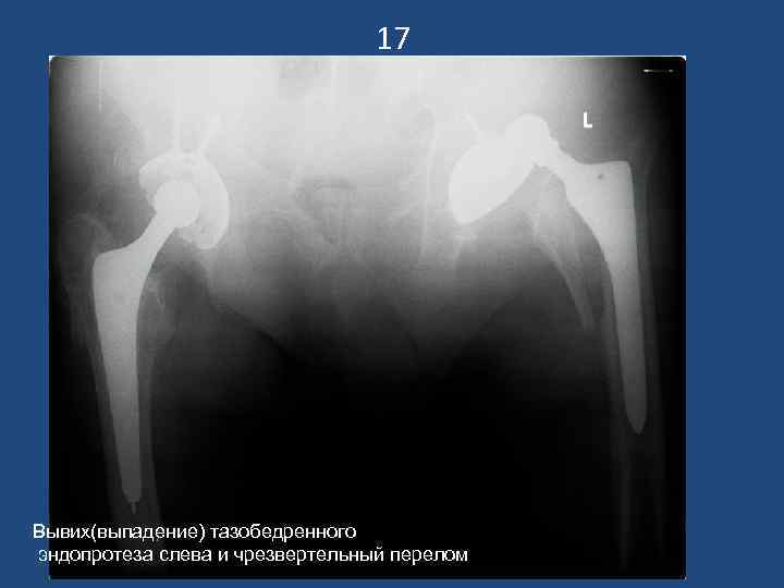        17 Вывих(выпадение) тазобедренного эндопротеза слева и чрезвертельный