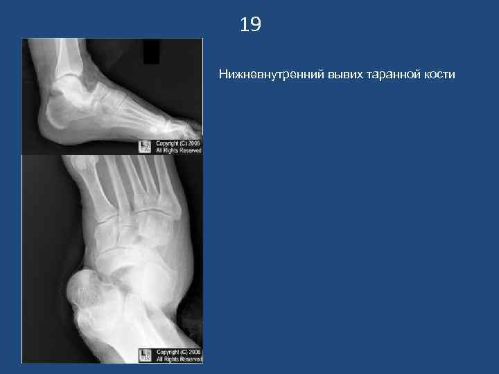   19 Нижневнутренний вывих таранной кости 