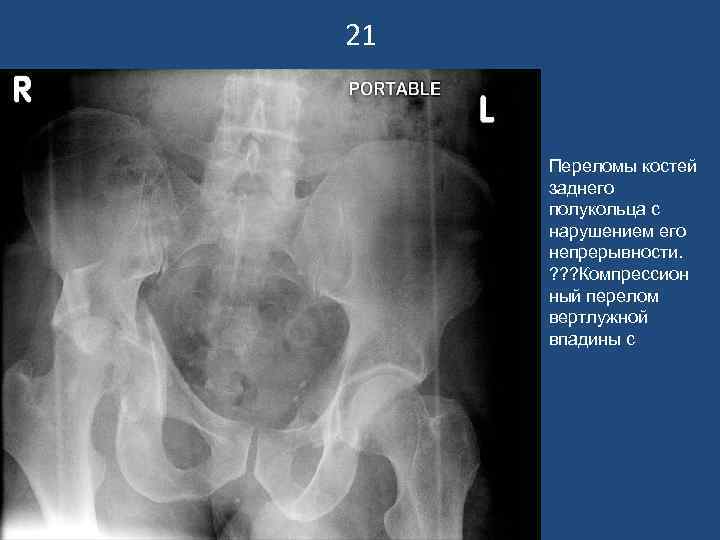21  Переломы костей заднего полукольца с нарушением его непрерывности.  ? ? ?