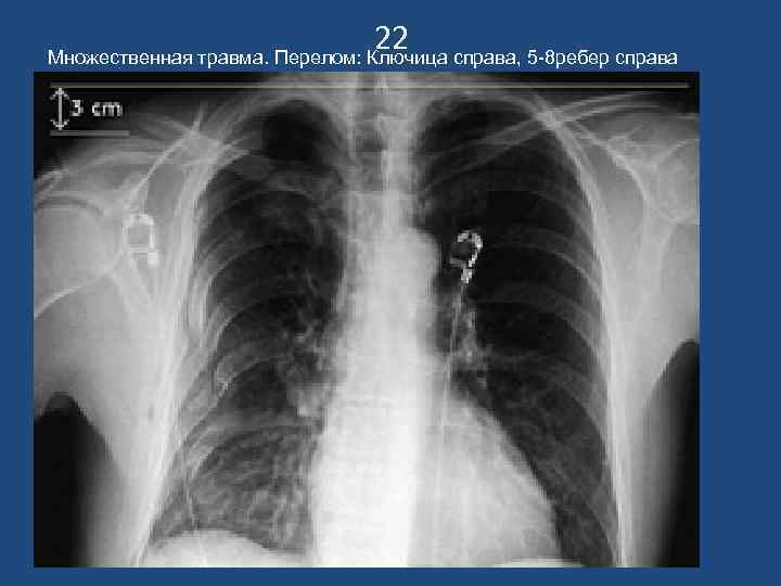       22 Множественная травма. Перелом: Ключица справа, 5 -8