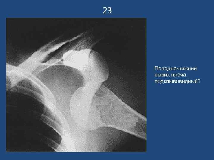 23   Передне-нижний вывих плеча подклювовидный? 